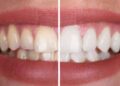 Cómo lograr un blanqueamiento dental seguro y qué métodos pueden dañar el esmalte