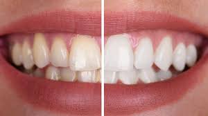 Cómo lograr un blanqueamiento dental seguro y qué métodos pueden dañar el esmalte