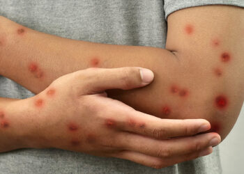 Mpox: se mantienen en 11 los casos confirmados