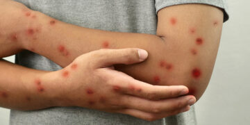 Mpox: se mantienen en 11 los casos confirmados